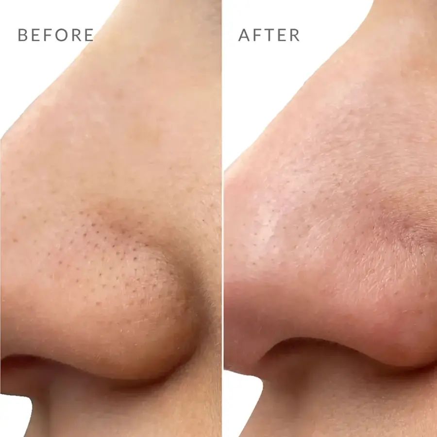 Réspirer Pore Strips