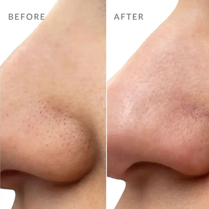 Réspirer Pore Strips